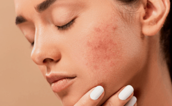 Understanding Dermatological Problems: Causes, Symptoms, and Treatments